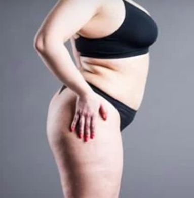 IF THERE’S NO CURE, HOW DO YOU TREAT LIPEDEMA?
