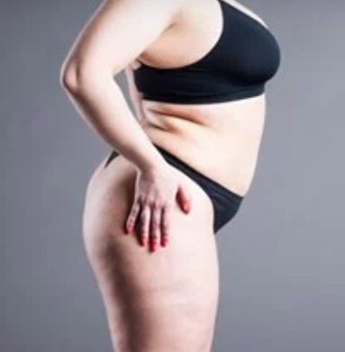 Lipedema Treatment in Beverly Hills, CA and Tucson, AZ