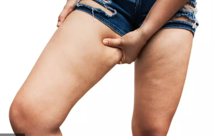 THE 4 STAGES OF LIPEDEMA–A CLOSER LOOK AT EACH ONE