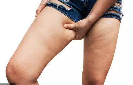 Lipedema Treatment in Beverly Hills, CA and Tucson, AZ