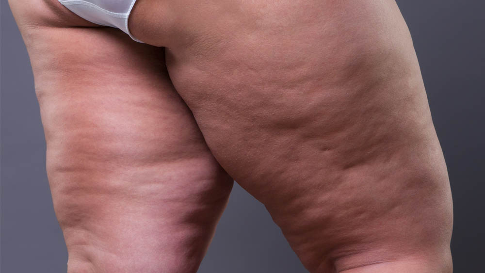 Manual Lipedema Extraction Before and After Pictures in Beverly Hills, CA and Tucson, AZ