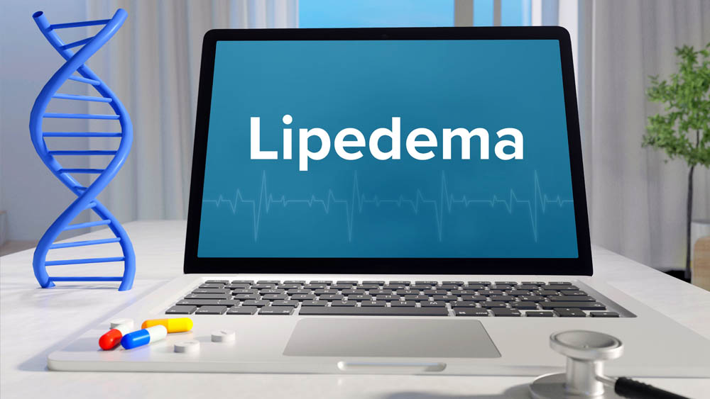 Lipedema Stages And Types