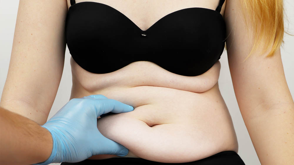 Tummy Tuck in Beverly Hills, CA and Tucson, AZ