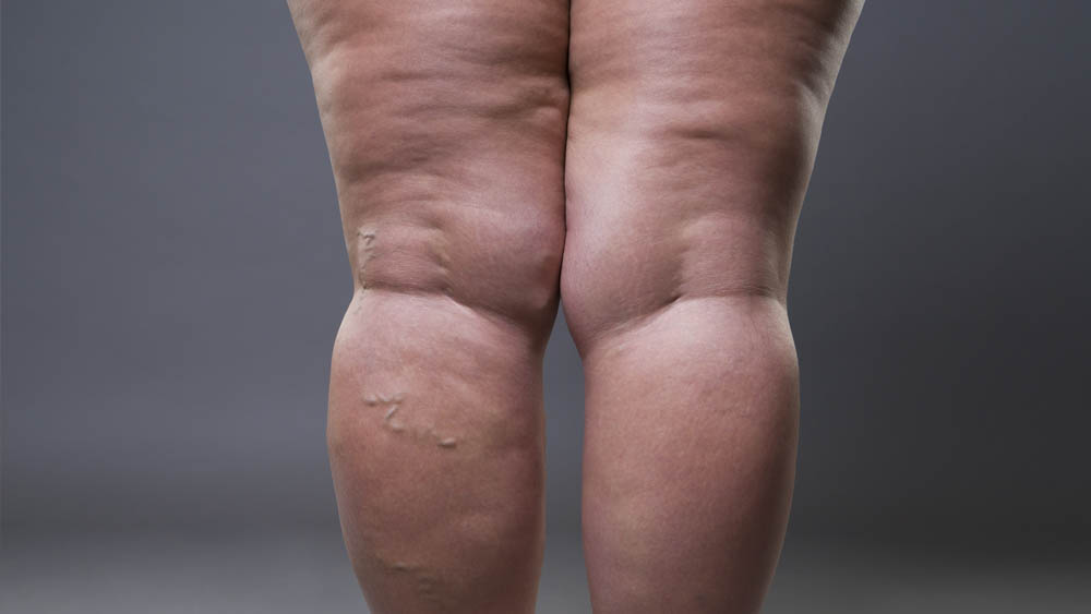 Lipedema Treatment in Beverly Hills, CA and Tucson, AZ