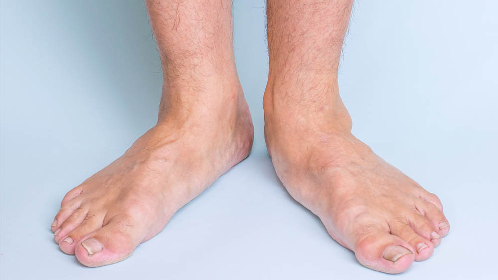 Flat Feet and Lipedema Before and After Pictures in Beverly Hills, CA and Tucson, AZ