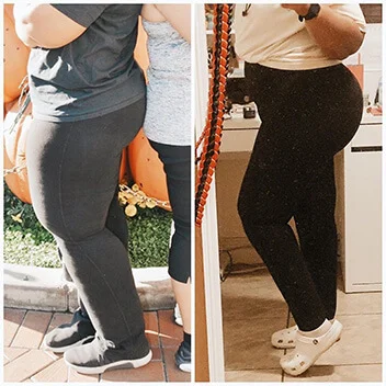 Journey6 Lipedema Treatment Before & After Pictures in Beverly Hills, CA & Tucson, AZ