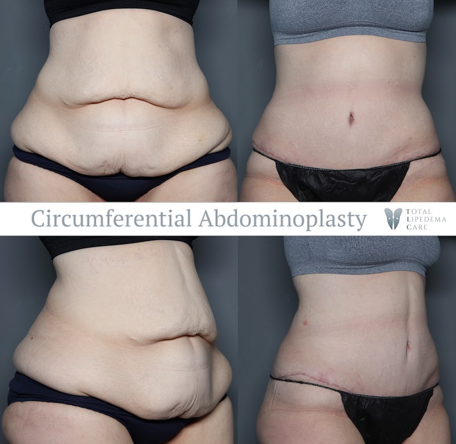 Lipedema Treatment Before and After Pictures in Beverly Hills, CA and Tucson, AZ