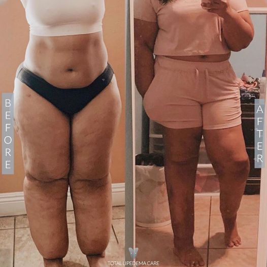 Lipedema Surgery Before and After Photos are actual patients.