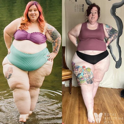 Lipedema Surgery Before and After Photos are actual patients.