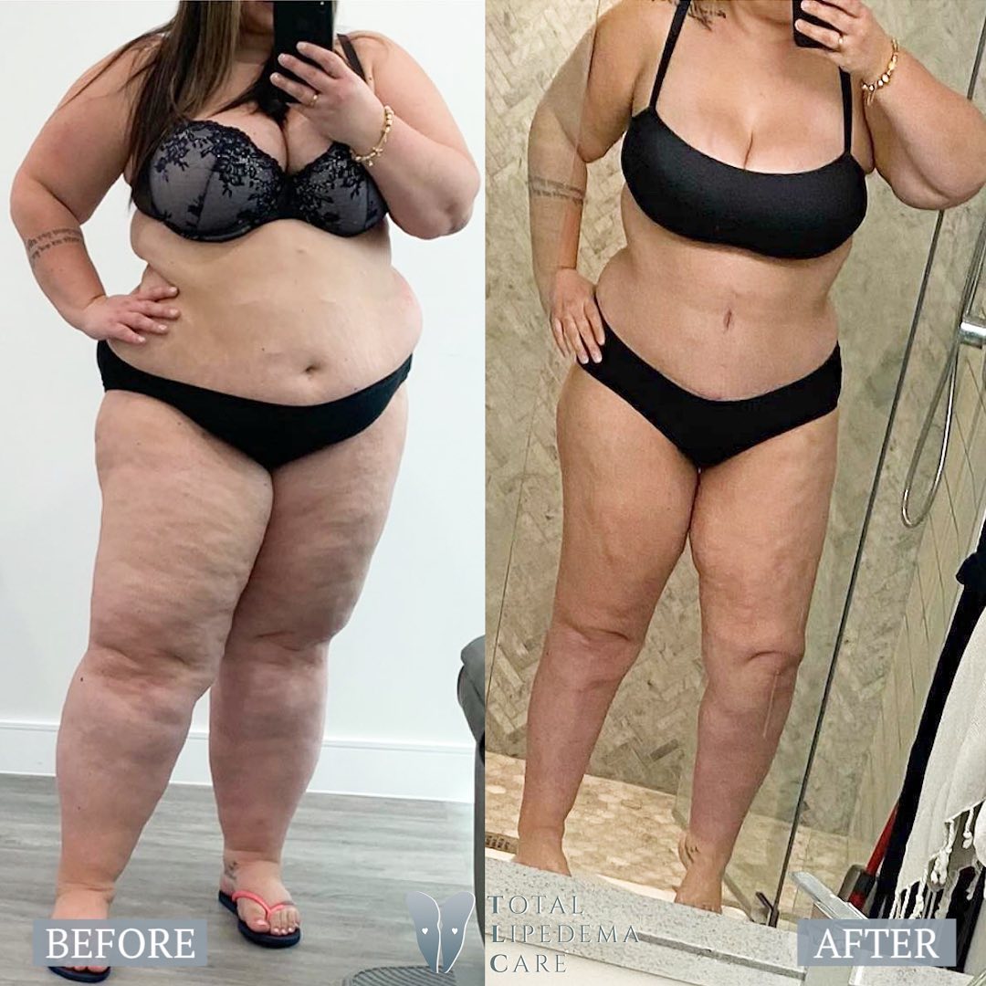 Lipedema Treatment Before and After Pictures in Beverly Hills, CA and Tucson, AZ