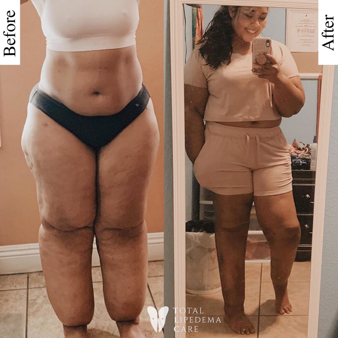 Lipedema Treatment Before and After Pictures in Beverly Hills, CA and Tucson, AZ