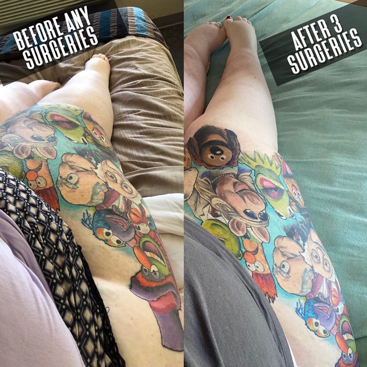 before1 Lipedema Treatment Before and After Pictures in Beverly Hills, CA