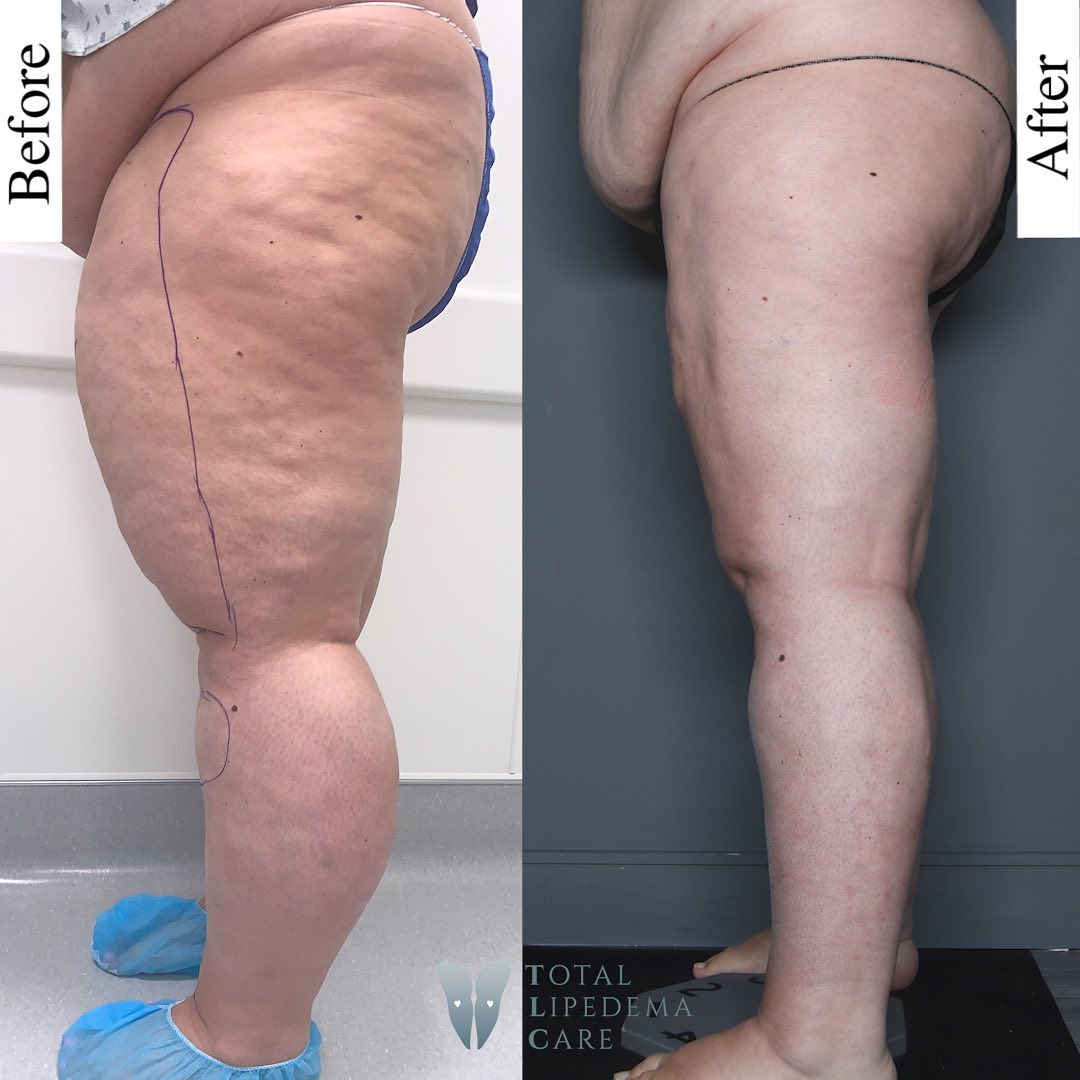 Lipedema Treatment Before and After Pictures in Beverly Hills, CA and Tucson, AZ