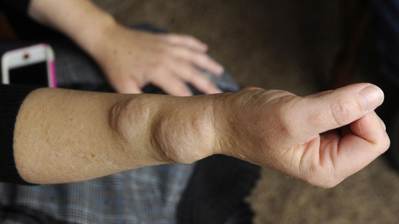 Injury from workout concept : Asian man use hands hold on his kn Dercum’s Disease
