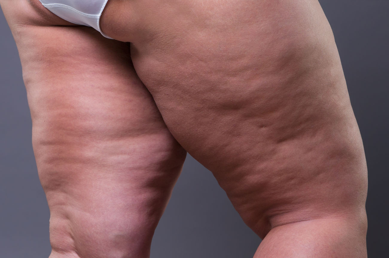 Injury from workout concept : Asian man use hands hold on his kn Lipedema