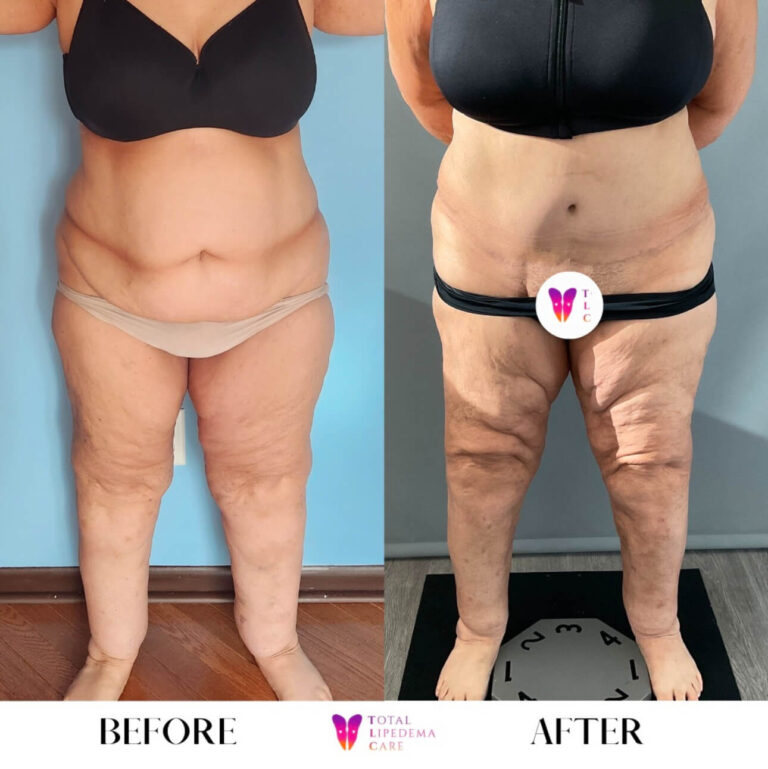 TLC Before and after