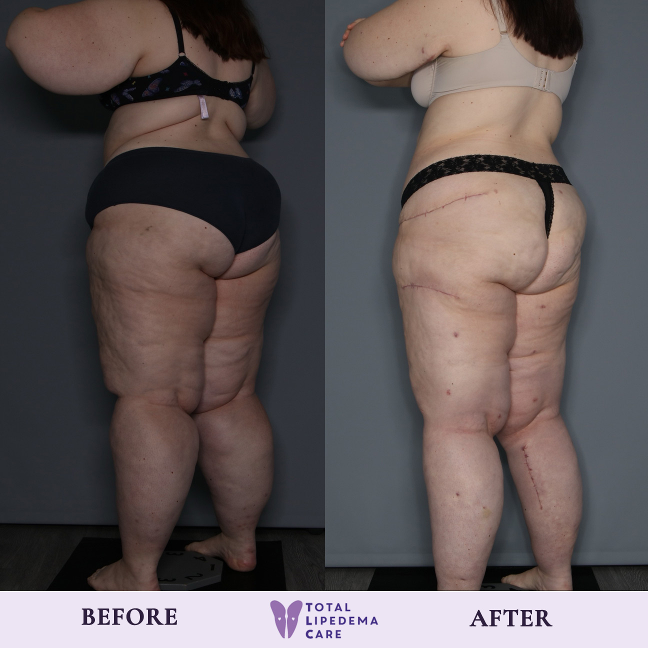 before1 Lipedema Treatment Before and After Pictures in Beverly Hills, CA
