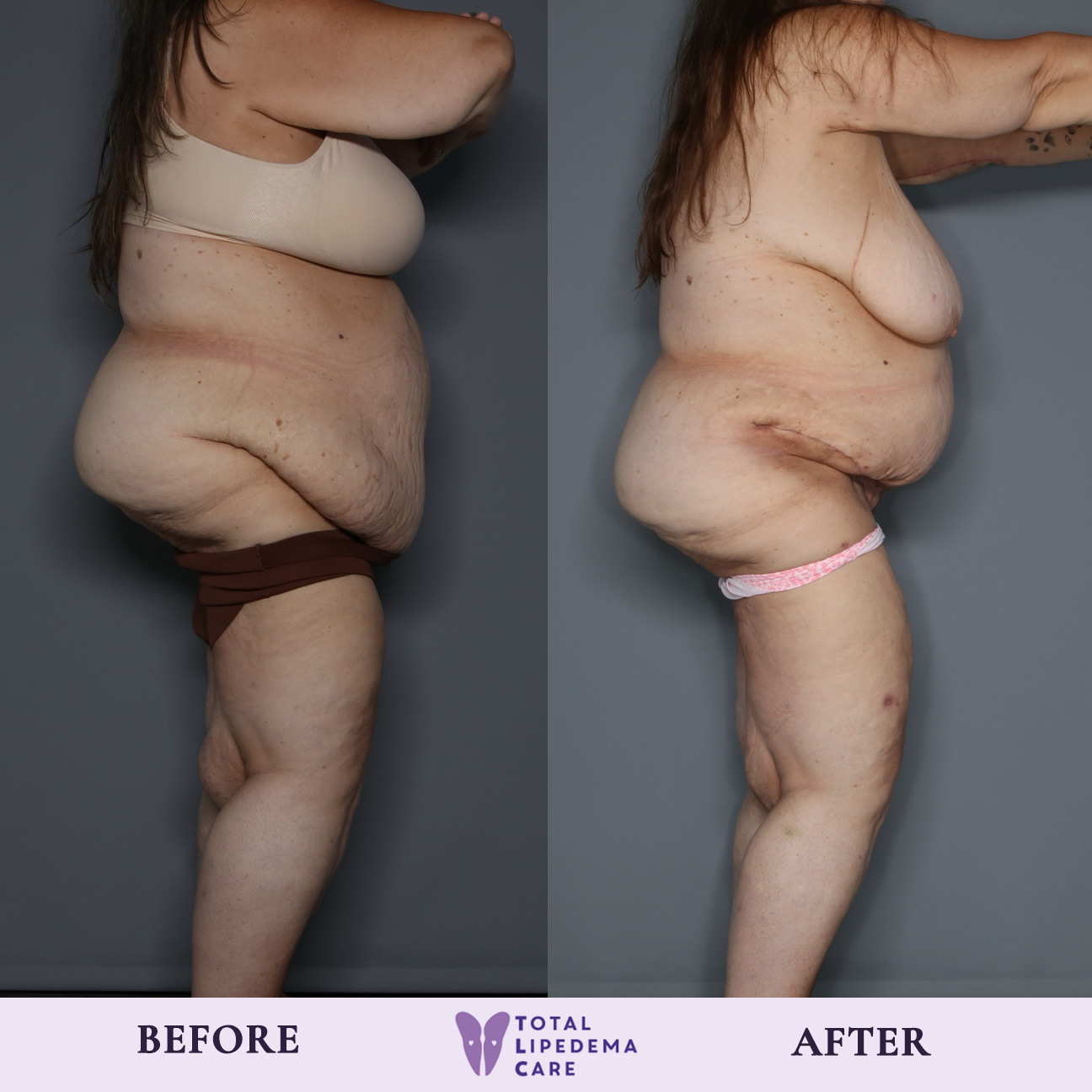 before1 Lipedema Treatment Before and After Pictures in Beverly Hills, CA