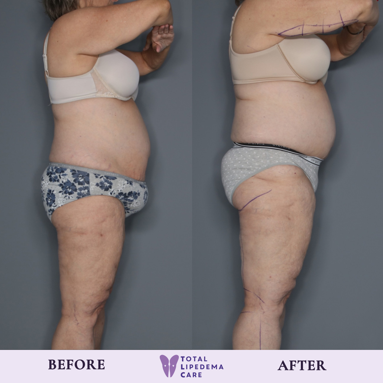 before1 Lipedema Treatment Before and After Pictures in Beverly Hills, CA