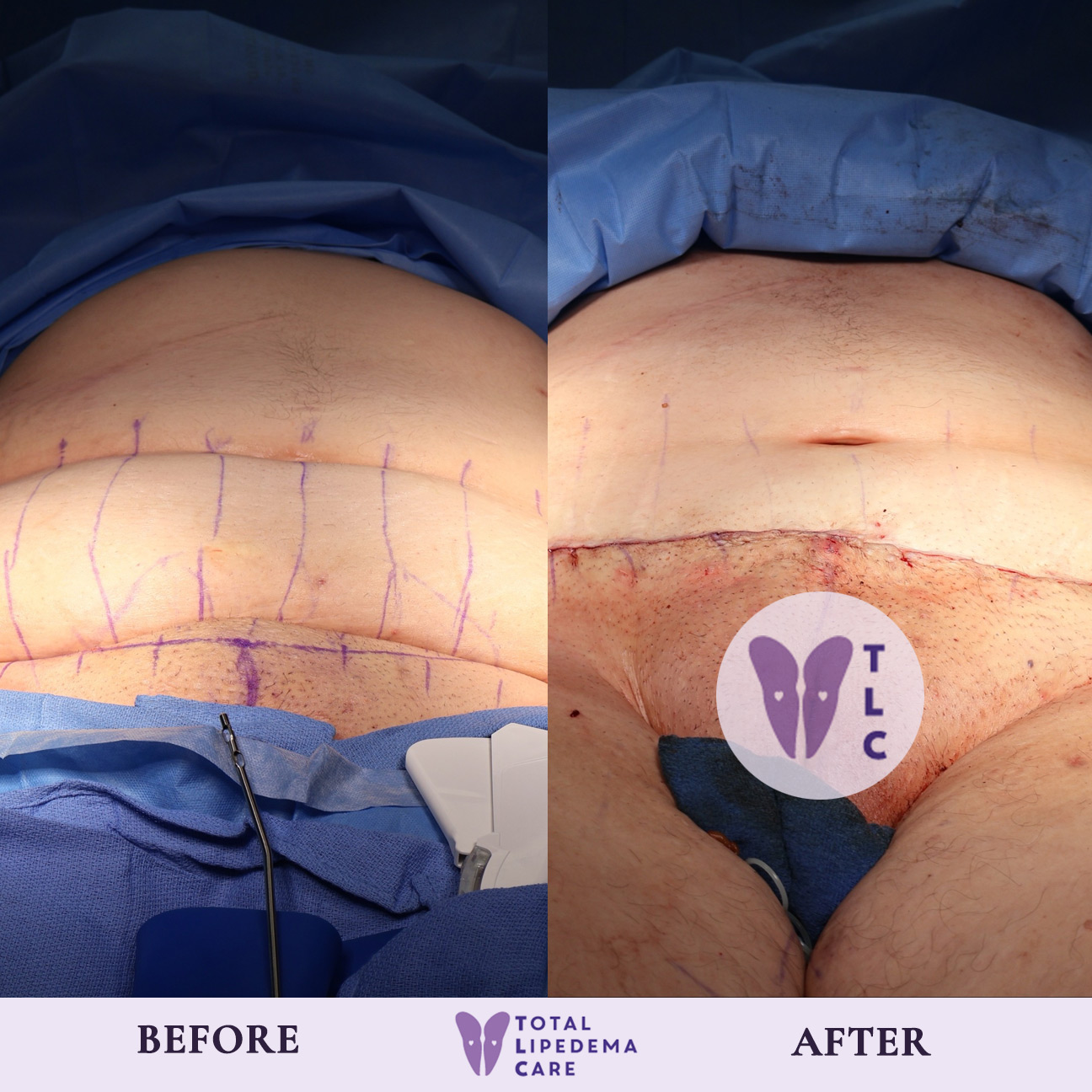 TLC Before and after TLC Before and after