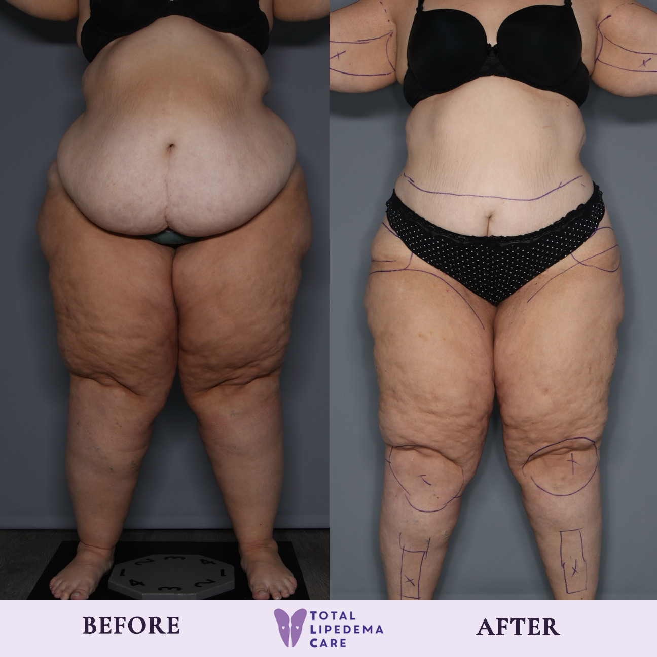 before1 Lipedema Treatment Before and After Pictures in Beverly Hills, CA
