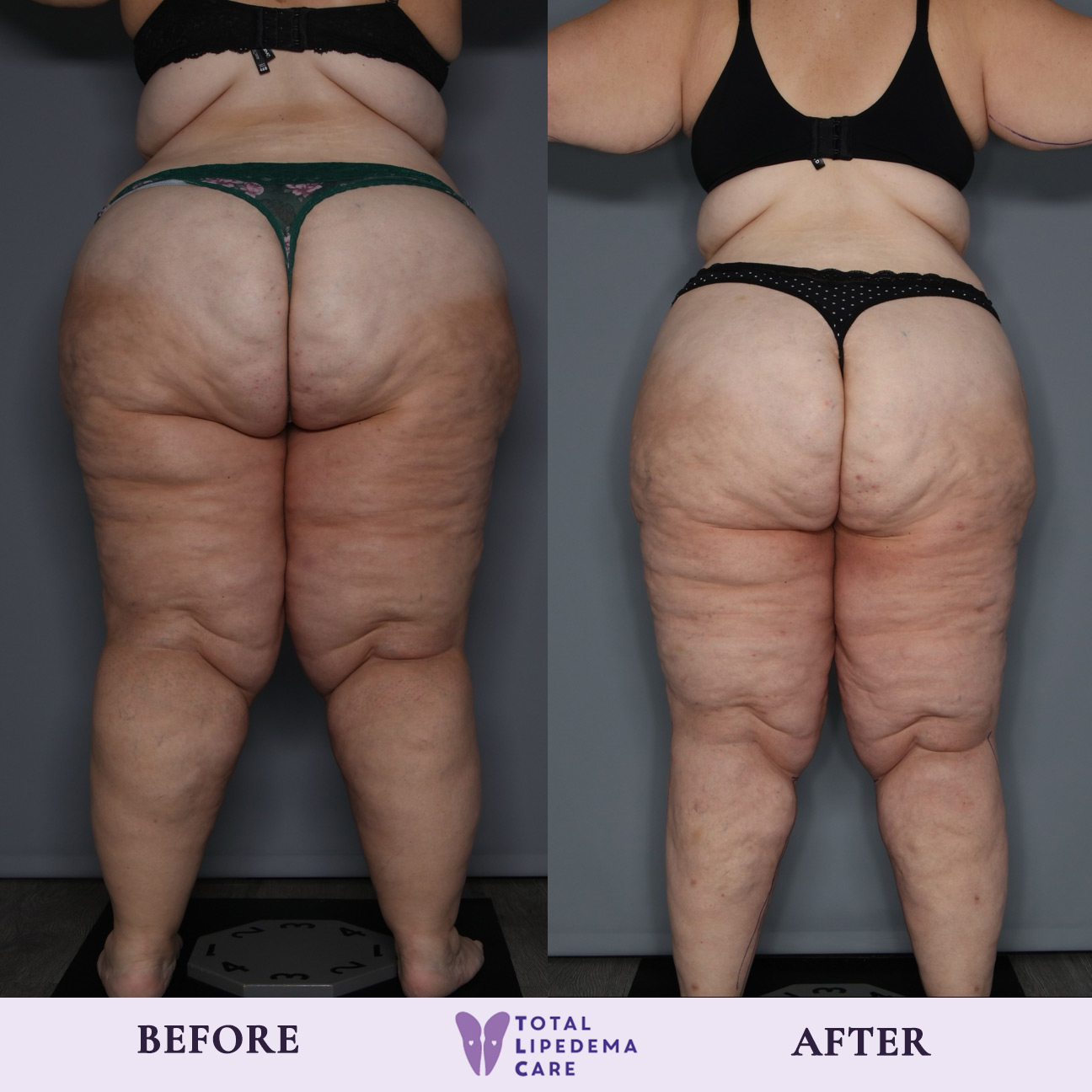 before1 Lipedema Treatment Before and After Pictures in Beverly Hills, CA