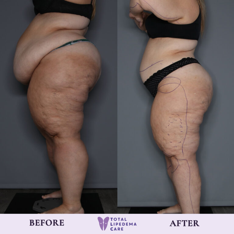 TLC Before and after