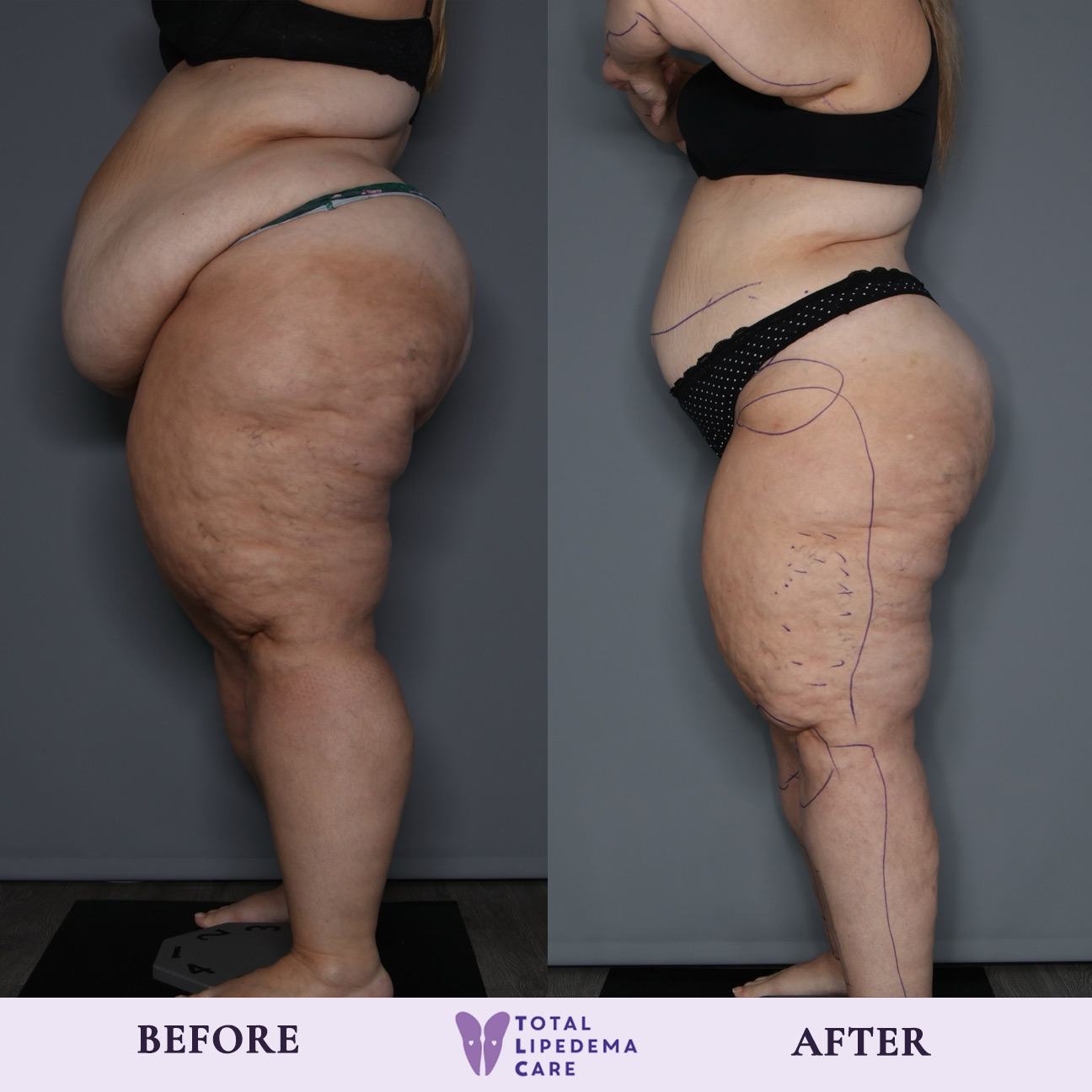 TLC Before and after TLC Before and after