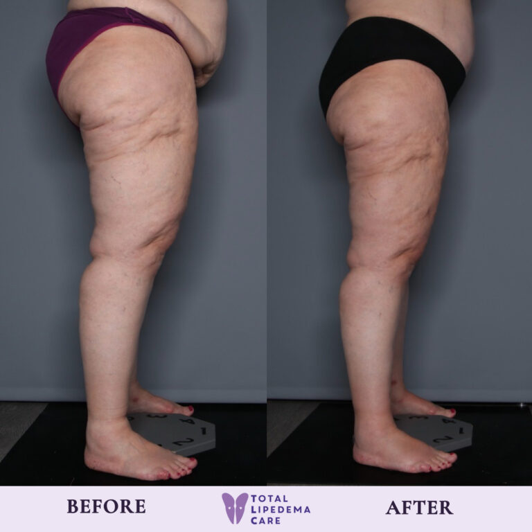 TLC Before and after