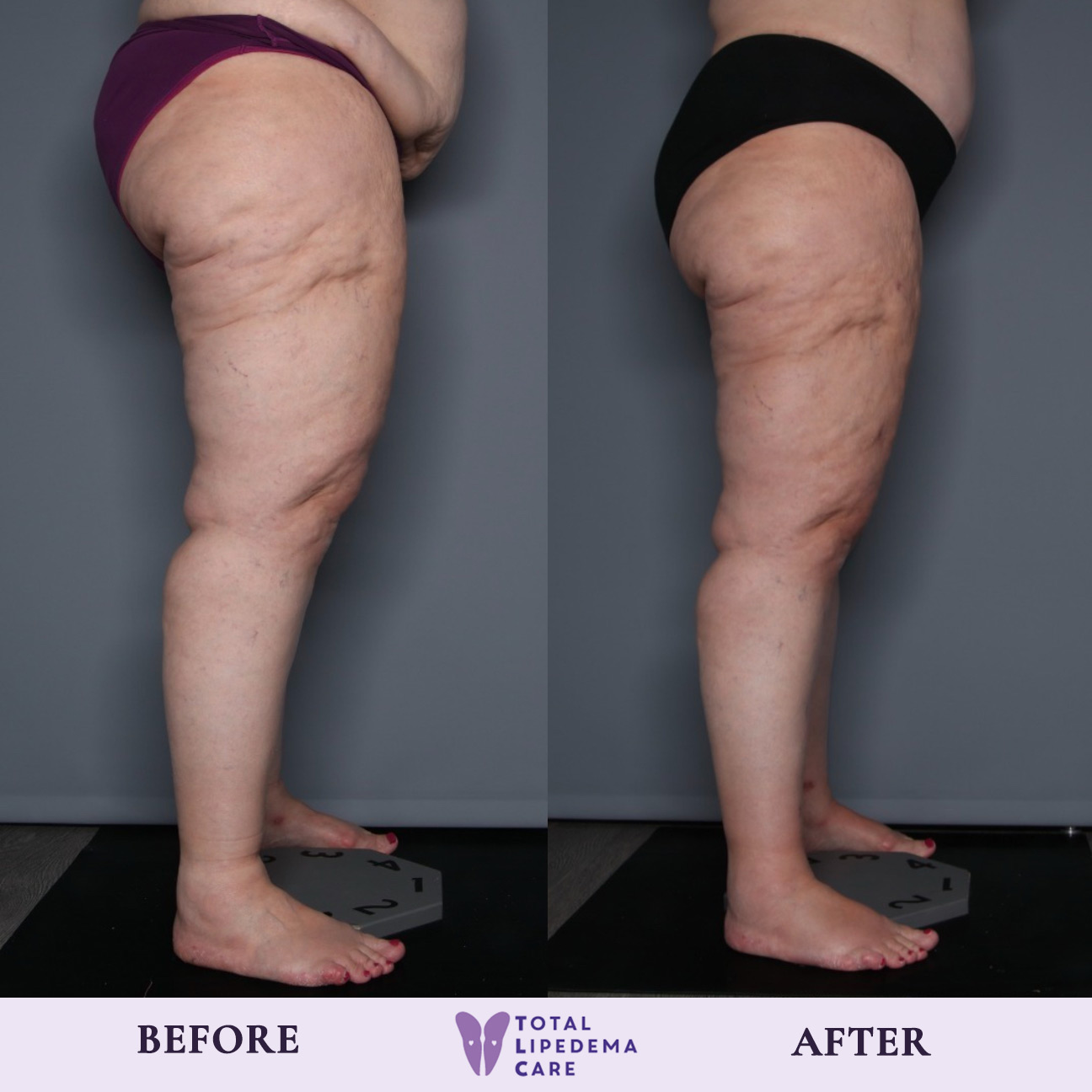 TLC Before and after TLC Before and after