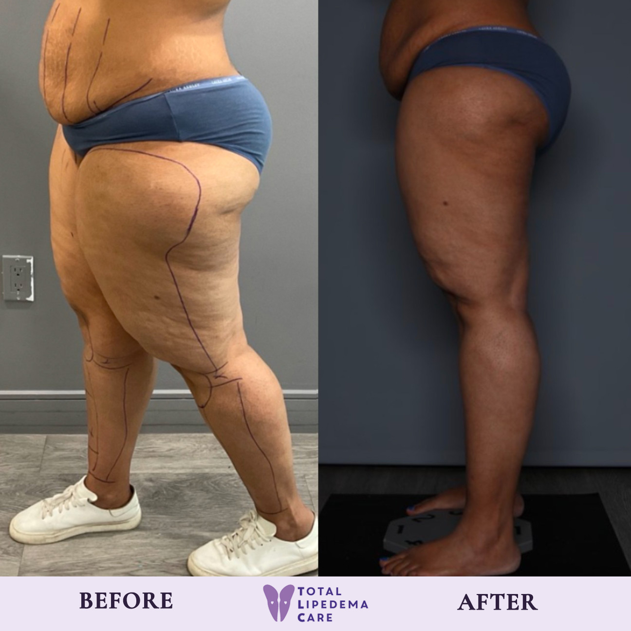 TLC Before and after TLC Before and after