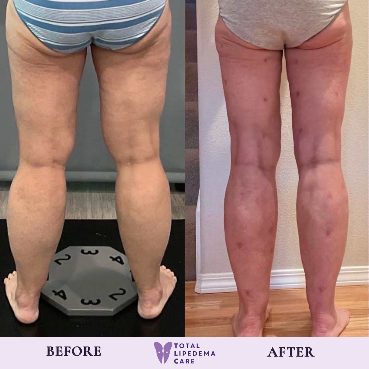 before1 Lipedema Treatment Before and After Pictures in Beverly Hills, CA